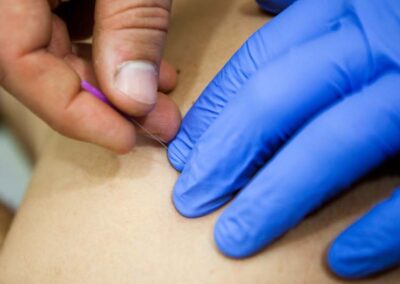 Dry needling